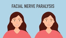 Facial nerve paralysis concept vector illustration. Face palsy.