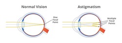 Astigmatism, refractive or refraction error. Eye disorder, eye does not focus light evenly on the retina. Blurry, blurred, or distorted vision. The illustration is isolated on a white background. 