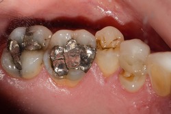 A large amalgam or metal-mercury fillings on molar teeth and premolar tooth fracture