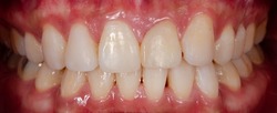 improper and uneven size of front teeth and missing left lateral incisor