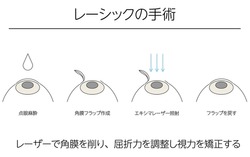 LASIK - Translation: LASIK surgery, laser shaving of the cornea to adjust refractive power and correct vision, ophthalmic anaesthesia, corneal flap creation, excimer laser radiation, return of flap.