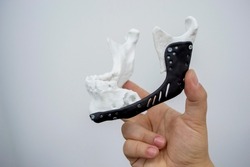 Man holding implantation of endoprosthesis of lower jaw. Model of lower jaw printed on 3D printer white plastic. Endoprosthesis printed on 3D printer for metal biocompatible titanium alloy black color