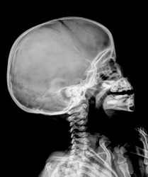 film x-ray skull of child