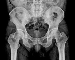 Scanning of an anterior posterior radiograph of the pelvis taken, among others radiographs, to try to detect the origin of pain in the hip of an adult man