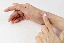 Applying a special medical cream or salve  to a healing scar after tendon surgery on a woman's hand. Scar care for elasticity.