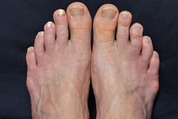 Closeup of two caucasian feet, one with mycosis, fungal nail infection, the other not infected, side by side comparison, reference point of fungus infected toe nails versus non infected toe nails, blu