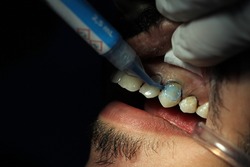 Dentist placing acid on an upper tooth as part of the bonding of a restoration.