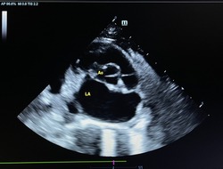 Echocardiographic finding shows short axis of the heart at left atrium (LA) and aorta (Ao) level in feline cardiomyopathy