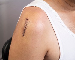 Front side closeup view of surgical incision on upper right shoulder joint closed with sutures