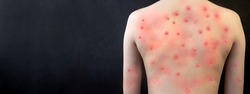 MONKEYPOX. The girl's skin is blistered from monkeypox. Virus, epidemic, disease.Black background.
