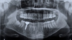 Panoramic black and white image dental x-ray of adult with single dental implant. Roentgen teeth upper and lower jaw. Negative shot of the digital picture