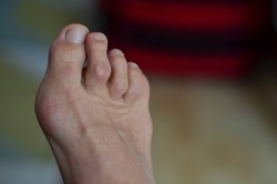 Closeup of barefeet woman with  Medical condition called bunions or hammer toes  feet problem.