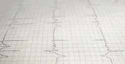 Cardiogram chart with medical table closeup, for Surgeon heart record, selective focus