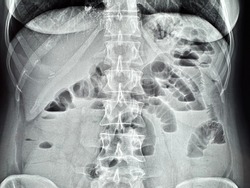 x-ray acute intestinal obstruction, intestinal arches