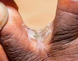 Using hands to expose chronic interdigital athlete's foot between middle and ring toe of a right foot of early thirties male. Dead layers of soft skin and erosions are visible due to long infection