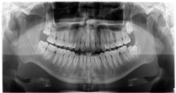 Orthopantomography, OPG X-ray DR digital wisdom teeth