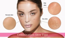 Female face with different skin types - dry, oily, normal, combination. T-zone. Skin problems. Beautiful brunette woman and facial diseases: acne, wrinkles. Skincare, healthcare, beauty, aging process