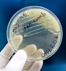 Ear swab culture, Microbiologist hand hold a petri showing a colony of bacteria
