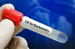 Biochemist hold Cerebrospinal fluid (CSF) sample for biochemistry test including glucose, protein, ADA
