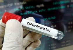 Biochemist hold Cerebrospinal fluid (CSF) sample for Protein testing.