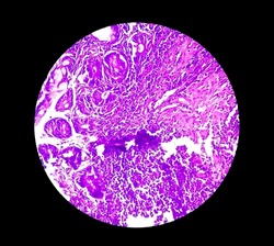 Tissue from terminal ileum: Chronic nonspecific ileitis or inflammation of the ileum, is often caused by Crohn's disease. inflammatory bowel disease (IBD).