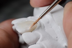 Ceramic powder baking procedure of fabricating porcelain laminated veneer. Ceramic dental veneer to correct tooth color.