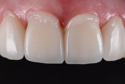 Intra oral try in step or mock up before permanent bonding and installation of dental ceramic veneers.