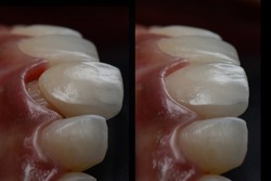 Intra oral try in step or mock up before permanent bonding and installation of dental all ceramic single crown. lateral view with black background. Before and after.