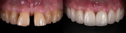 Dental crown and veneer before and after. Smile makeover with dental ceramic veneers treatment, result in clean, well aligned,perfect, youth and white teeth smile. 