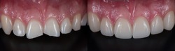 Treatment for front teeth fracture with dental ceramic veneers.