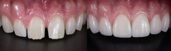 Correction of spacing teeth with dental ceramic veneers, before and after.