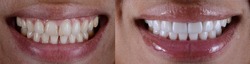 Teeth whitening by dental veneers, full smile smile makeover with porcelain laminated veneers.