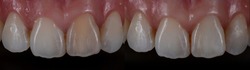 Non vital teeth bleaching or internal bleaching, before and after shot. Individual teeth whitening on one central incisor.