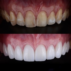 Smile makeover with porcelain laminated veneers result in perfect smile and Hollywood white color.