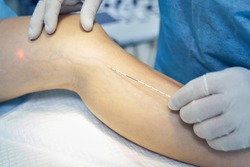 Process of laser treatment of vein disorders