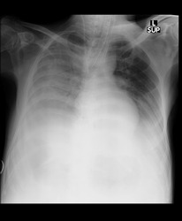 ICU Aspirate pneumonia Patient chest xray saturation Droped