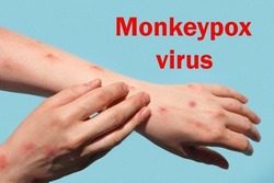 Monkeypox new disease dangerous over the world. Patient with Monkey Pox. Painful rash, red spots blisters on the hand. Close up rash, human hands with Health problem. The word Monkeypox virus.