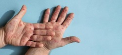 Male hands with Monkeypox rash. Patient with MonkeyPox viral disease. Close Up of Painful rash, red spots blisters on the skin. Human palm with Health problem. Banner, copy space. Allergy, dermatitis.