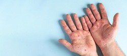 Male hands with Monkeypox rash. Patient with MonkeyPox viral disease. Close Up of Painful rash, red spots blisters on the skin. Human palm with Health problem. Banner, copy space. Allergy, dermatitis