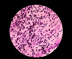 Pap's smear microscopic 100x show reactive cellular changes associated with severe inflammation at human cervix cells.Squamous epithelial cells.
