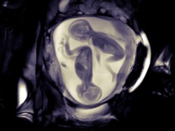 Ultrasography (USG) animal scan after 30 weeks of pregnancy show normal twin babies.