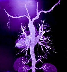 CT Angiography (Computed tomography angiography: CTA) of abdominal aorta, Rupture of an abdominal aortic aneurysm

