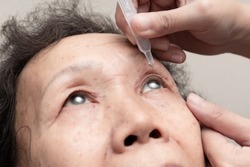 Close up of elder woman drips eye drops into her eyes. Treatment for eye diseases. Healthcare concept