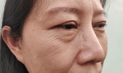 portrait showing the flabbiness and wrinkles skin under the eyes, problem flabby skin on the face of the woman, concept health care.
