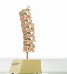 A model of the human spine that shows various defects in the bones and vertebrae. Inscriptions on the model: 1-Compression fracture, 2-Normal vertebral bone, 3-Ostioporotic bone, 4-Wedge fracture.