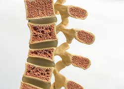 Model of the human spine on a white background, which shows various defects in bones and vertebrae. From top to bottom: normal vertebral bone, osteoporotic bone, wedge fracture, compression fracture.