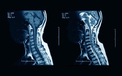 MRI scans of the cervical spine, with and without contrast media, MRI with bilateral C7 nerve root compression, Cervical spondylosis.