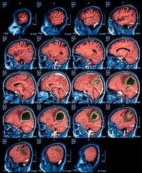 Magnetic resonance imaging (MRI) of the brain, brain tumor, sagittal view