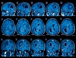 Magnetic resonance imaging (MRI) of the brain, brain tumor, three views (sagittal, coronal and transverse)