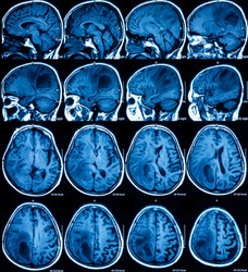Magnetic resonance imaging (MRI) of the brain, brain tumor, two views (sagittal and transverse)